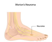 Nerve Damage May Lead to Morton’s Neuroma
